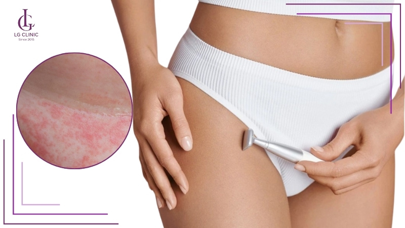 Không cạo khô vì dễ làm da đỏ rát, xước nhẹ và kích ứng sau cạo