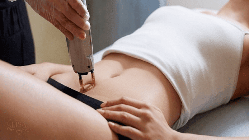 Ngoài cạo lông, chị em có thể chọn tỉa, waxing, kem tẩy lông hoặc triệt lông chuyên nghiệp
