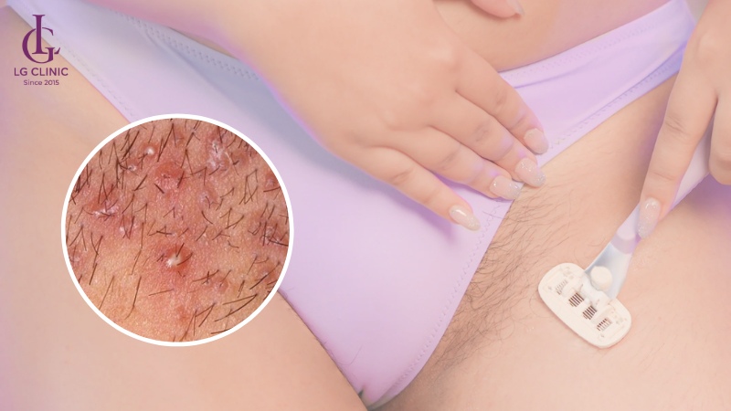 Khi da đau rát, nổi mẩn hoặc viêm, nên tạm dừng cạo đến khi phục hồi
